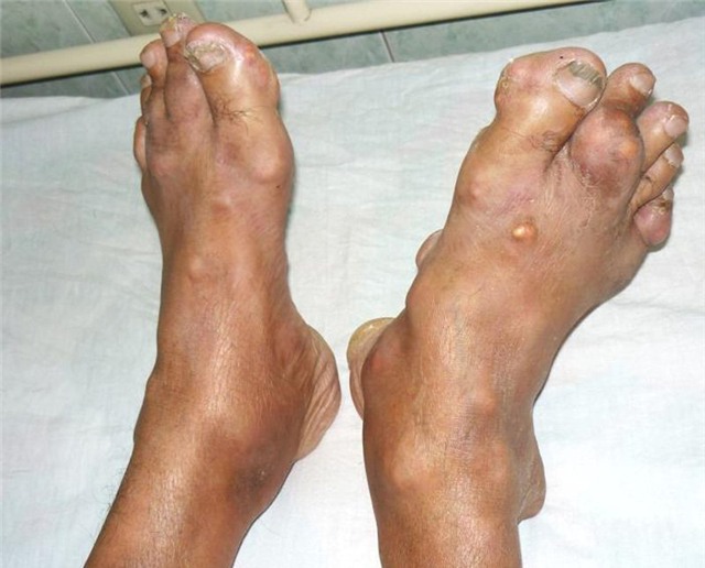 bệnh gút, tàn phế vì bệnh gút, chế độ ăn cho người bệnh gút, biến dạng tay chân, bến chứng bệnh gút, bệnh gout