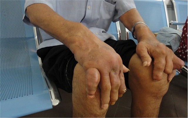 bệnh gút, tàn phế vì bệnh gút, chế độ ăn cho người bệnh gút, biến dạng tay chân, bến chứng bệnh gút, bệnh gout