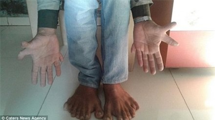 Suthar sở hữu 7 ngón tay, chân trên mỗi bàn tay, bàn chân