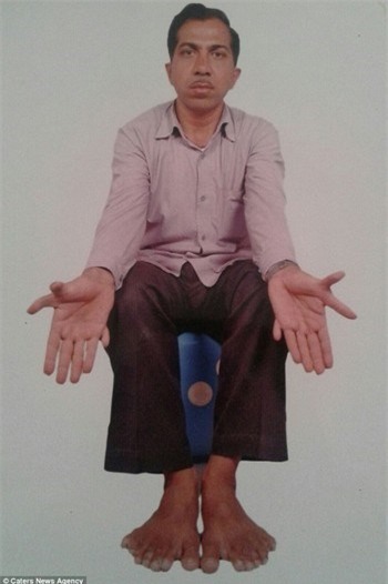 Chuyện kỳ lạ về người đàn ông có 28 ngón tay, chân - ảnh 1