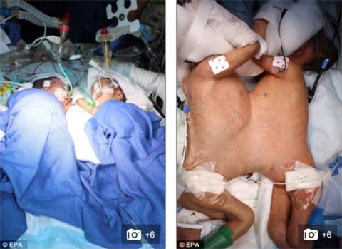 ky tich: tach roi hai be gai dinh lien than nho nhat the gioi hinh anh 1