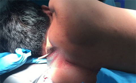 Nạn nhân nhập viện với cây kéo bị đâm trên lưng - Ảnh do bác sĩ cung cấp