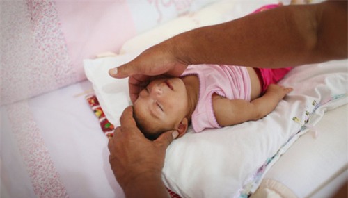 virus Zika, Zika, tật đầu nhỏ, teo não, mù, trẻ sơ sinh