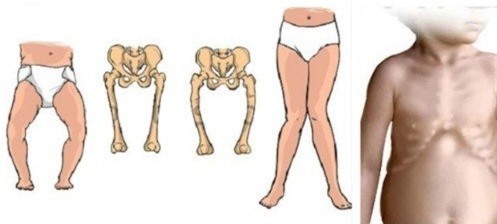 Bệnh còi xương ở trẻ em