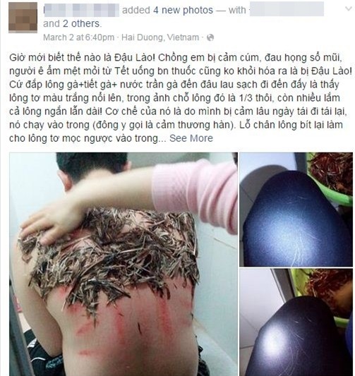 Đắp lông gà lên lưng để chữa bệnh đậu lào là phản khoa học - Ảnh 1.