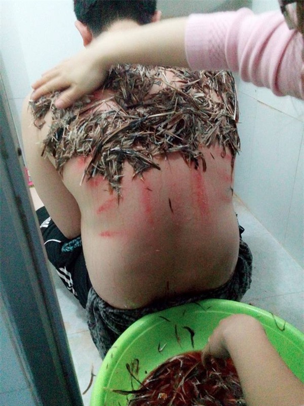 Đắp lông gà lên lưng để chữa bệnh đậu lào là phản khoa học - Ảnh 3.