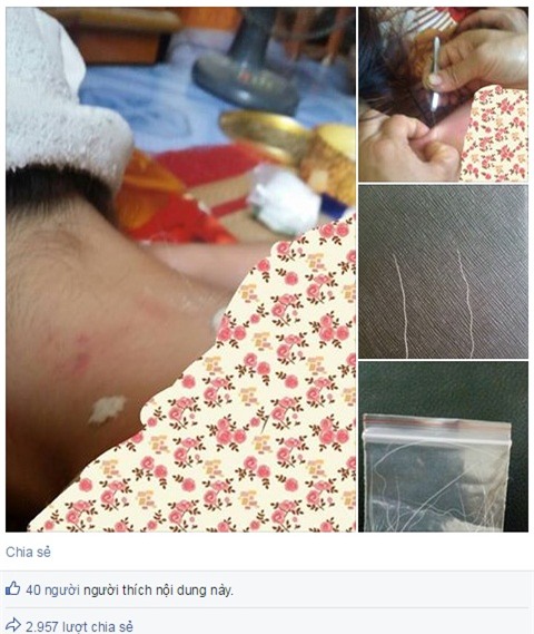 Đắp lông gà lên lưng để chữa bệnh đậu lào là phản khoa học - Ảnh 6.