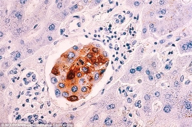 Thiếu hụt Vitamin D khiến ung thư vú phát triển nhanh hơn