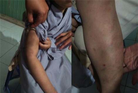 Bé gái bảy tuổi bị đánh bầm tím trong cơ sở tu tại gia - Ảnh 1.