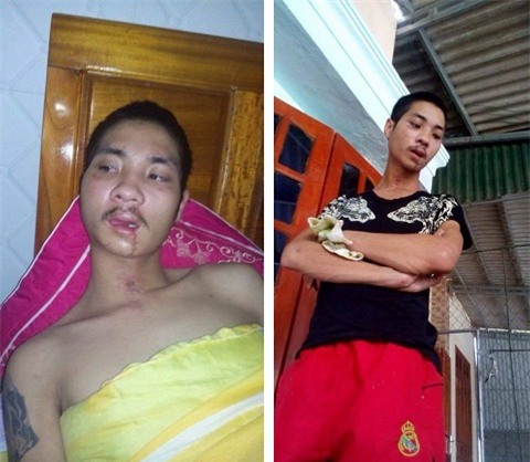 Vũ bị chấn thương sọ não và đa chấn thương nên mất trí nhớ, sức khỏe yếu.