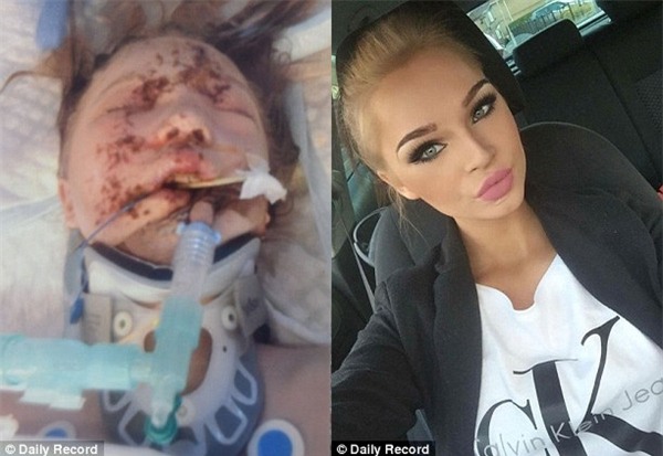 Sống sót sau tai nạn, cô gái phải cắt bỏ hoàn toàn khuôn mặt để tái tạo diện mạo mới - Ảnh 2.