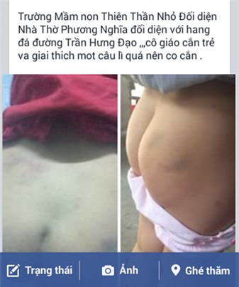 Hình ảnh mông cháu T. được cô giáo nựng bị thâm.