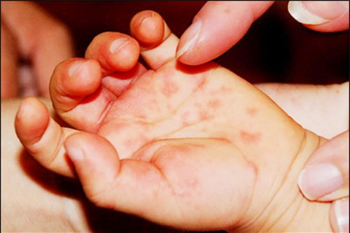 ha noi benh tay chan mieng dang bat dau gia tang - 1