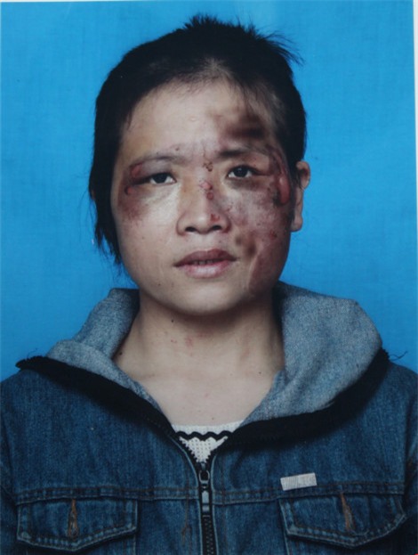 Chị Hồng cung cấp hình ảnh chị bị chồng bạo hành cắt tóc, nướng bát inox chà vào mặt.