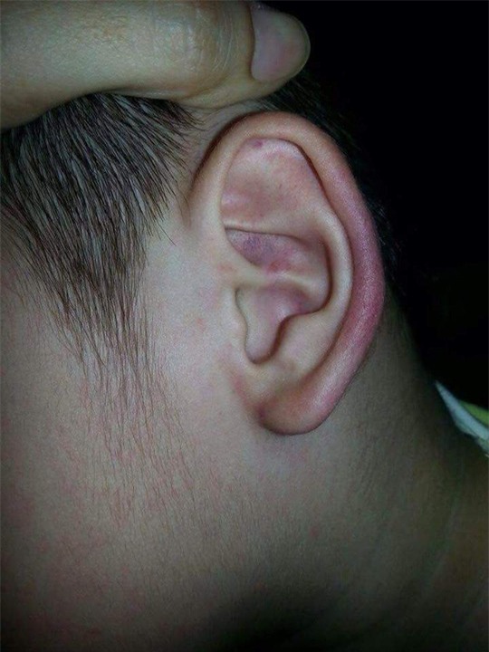Trẻ bị nhéo bầm tai