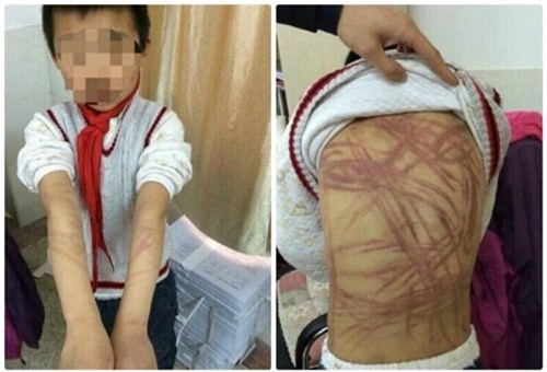 
Hình ảnh gây nhiều tranh cãi bởi vào tháng tư năm ngoái, giáo viên của cậu bé đã phát hiện cậu bé bị đánh đập rất dã man, cơ thể có nhiều chấn thương nặng nề, đặc biệt là ở lưng, bàn chân và bàn tay. Sau khi phát hiện, các giáo viên đã báo cáo lên cơ quan chức năng và Li Zhengqin phải chịu trách nhiệm trước pháp luật về hành vi ngược đãi trẻ em của mình.
