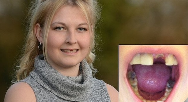 Thiếu nữ bị bệnh lạ hễ hắt hơi là rụng răng