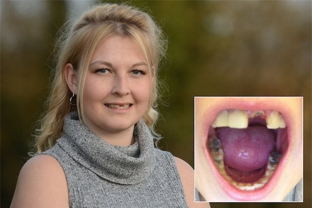 Linzi Grant bị căn bệnh lạ về răng.