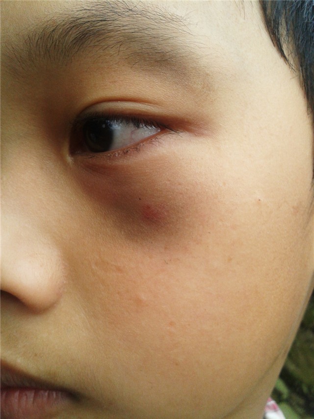 Vết bầm trên má Hoàng (ảnh do gia đình cung cấp).