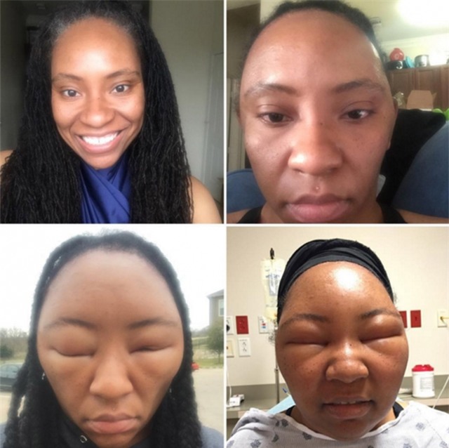 Mặt biến dạng không nhận ra vì sử dụng thuốc nhuộm tóc - Ảnh 1