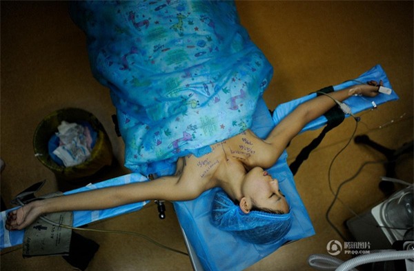 phẫu thuật nâng ngực