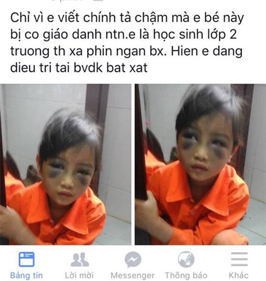 Hình ảnh học sinh Thủy bị đánh thâm tím mặt được đăng tải trên mạng xã hội