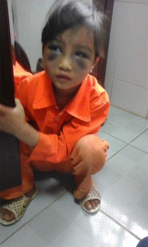 Bé Thủy đang được điều trị tại bệnh viện (ảnh: Ngọc Triển)