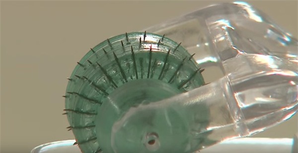 lăn kim trị quầng thâm bọng mắt