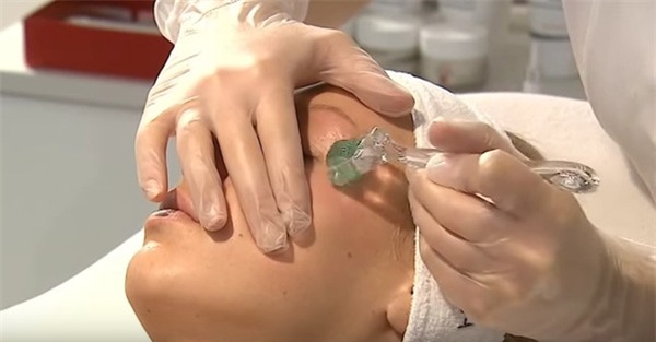 lăn kim trị quầng thâm bọng mắt