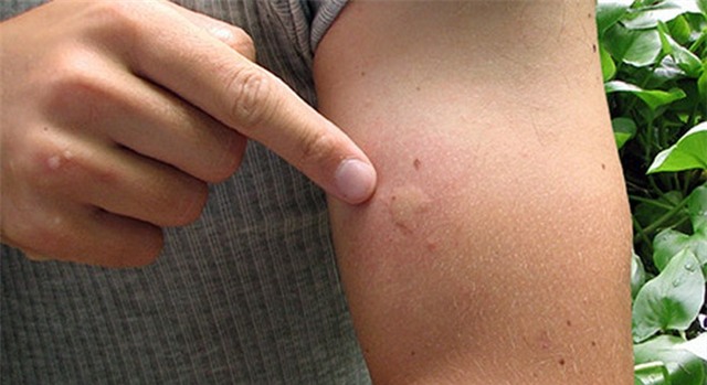 Việt Nam đã có 2 trường hợp nhiễm virus Zika, 1 người đang mang thai