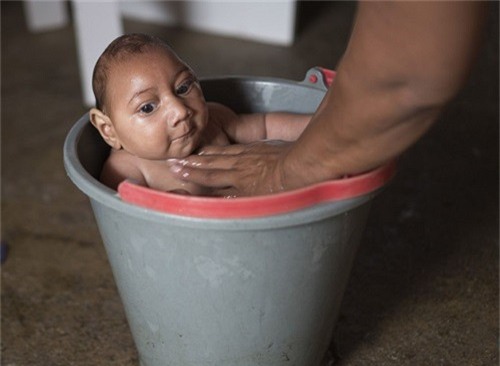 Thai phụ nhiễm Virus Zika ở Việt Nam: Thai nhi có mắc hội chứng đầu nhỏ? - Ảnh 2.