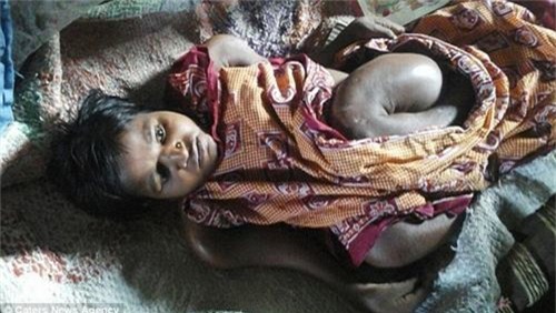 co gai 25 tuoi bi teo nho co the nhu be so sinh hinh anh 2