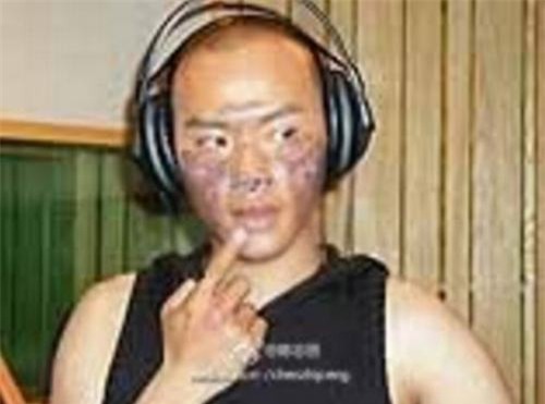 Sao Hoàn Châu cách cách bị bỏng nặng 3