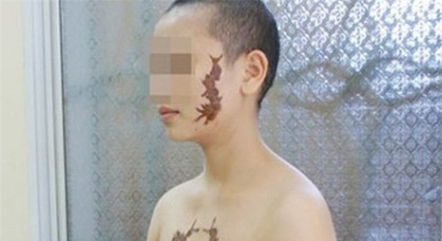 Cô gái mang hình xăm con rết thế nào sau 5 năm?
