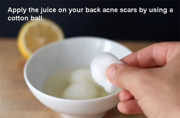 trị mụn ở lưng