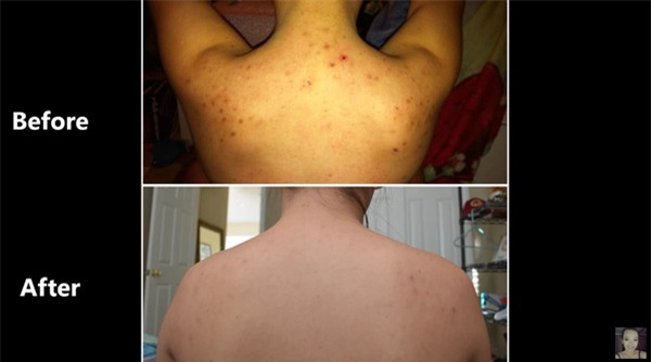 trị mụn ở lưng