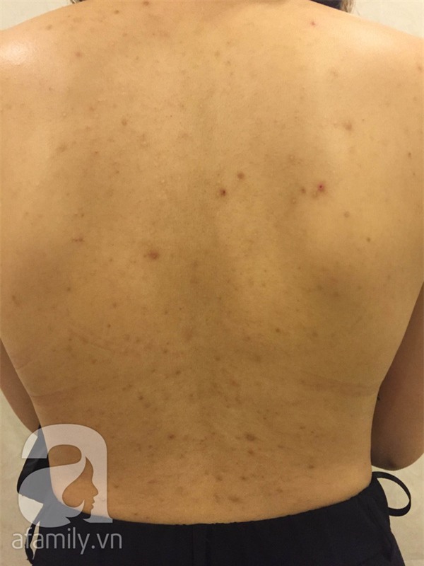 trị mụn ở lưng