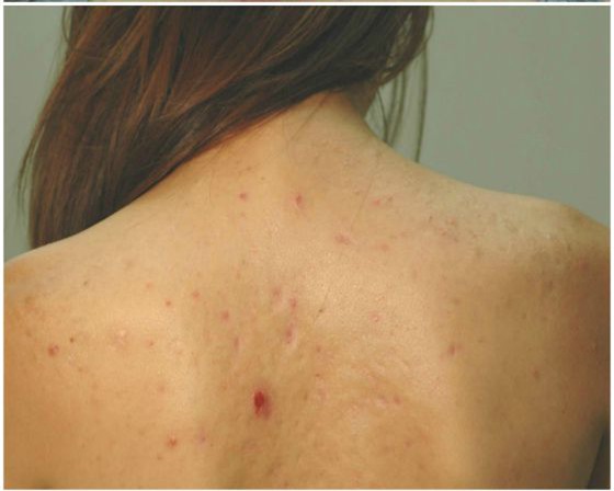 trị mụn ở lưng