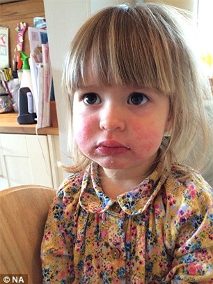 Bé gái bị nổi mẩn đỏ ở mặt do mẹ bé thường dùng giấy ướt để lau mặt.