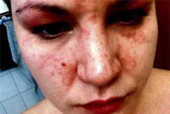 Một phụ nữ ở Australia đã phải nhập viện sau khi bị dị ứng với chất MI có trong khăn ướt. (Ảnh từ trang abc.net)