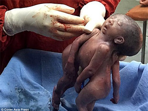 Hình ảnh đáng thương của cặp song sinh dính liền đầu - 2