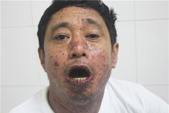 Các nốt ban đỏ khắp mặt, cổ, miệng bị lở loét khiến bệnh nhân không thể ăn hay nuốt được.