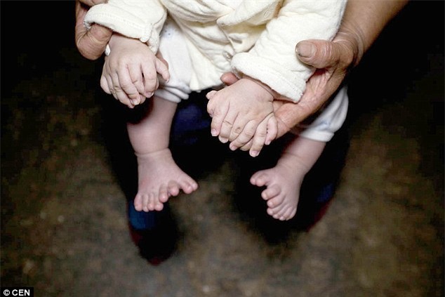 Cha mẹ cầu cứu vì con trai chào đời với 15 ngón tay và 16 ngón chân - Ảnh 1.