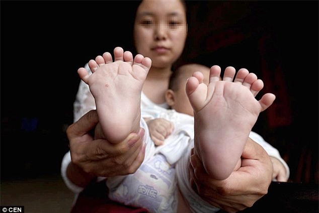Cha mẹ cầu cứu vì con trai chào đời với 15 ngón tay và 16 ngón chân - Ảnh 2.