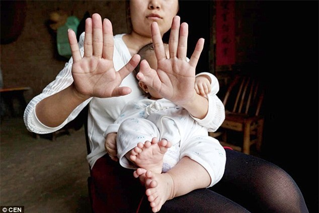 Cha mẹ cầu cứu vì con trai chào đời với 15 ngón tay và 16 ngón chân - Ảnh 4.