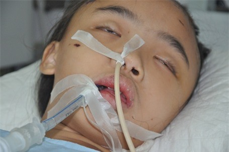 Em bị hôn mê sâu và thở máy.