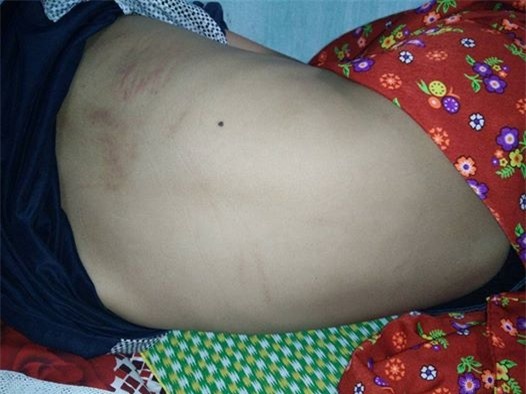 Vết mèo cào trên lưng bệnh nhi H.V.H.