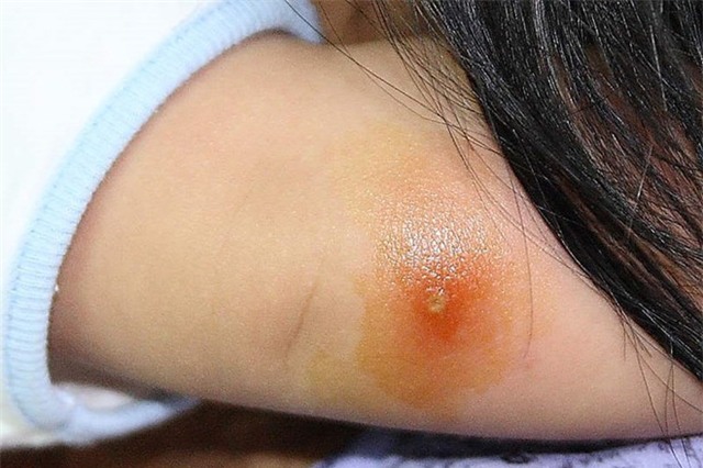 Con bị nhiễm trùng máu, nguy cơ tử vong cao vì vết thương rất nhỏ - Ảnh 3.