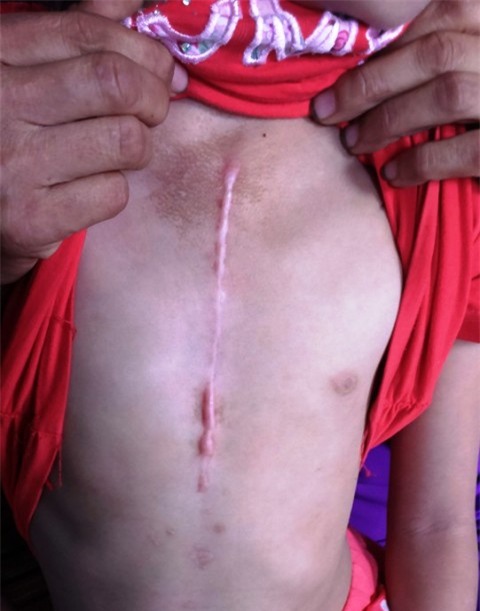 Cho đến khi có nhà tài trợ một nửa số tiền mổ, gia đình chị Tình mới có thể mổ tim cho con gái