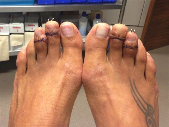 Bi kịch những đôi chân túa máu vì giày cao gót khiến chị em phát sợ - Ảnh 3.